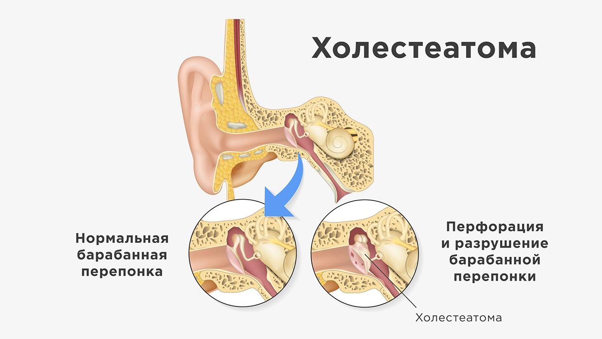 Холестеатома уха у ребенка - причины, симптомы и методы лечения